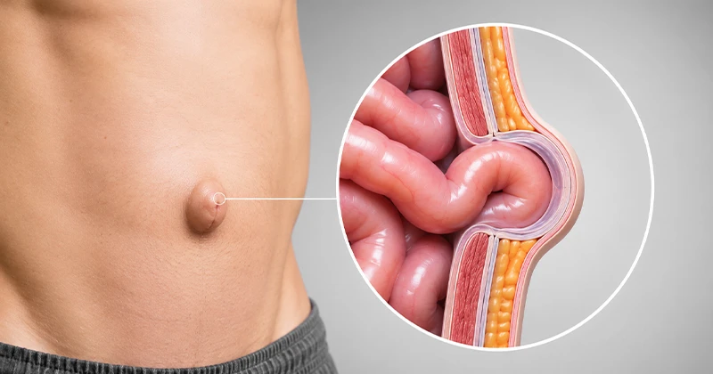 Hérnia abdominal: sintomas, riscos e quando procurar um cirurgião digestivo em Recife
