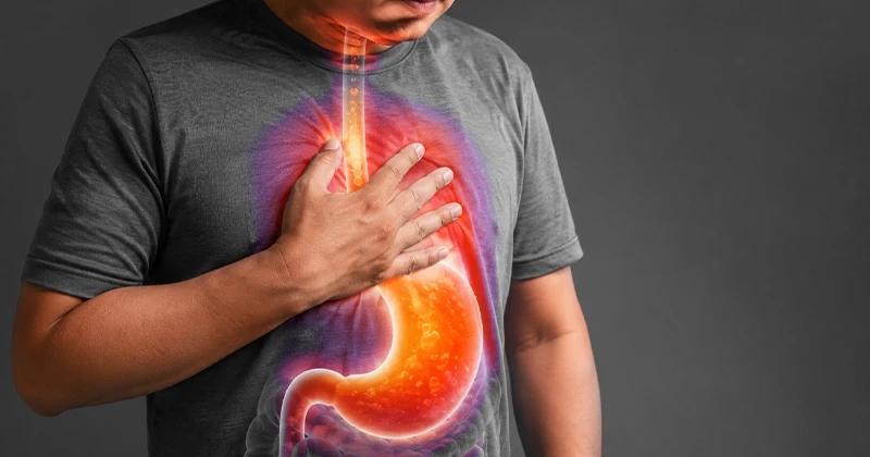 Refluxo gastroesofágico: azia, queimação, entalamento e quando procurar um cirurgião digestivo em Recife