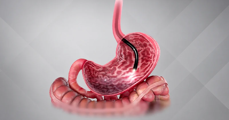 Exames digestivos: endoscopia, colonoscopia, ultrassom, tomografia e quando procurar um cirurgião digestivo em Recife